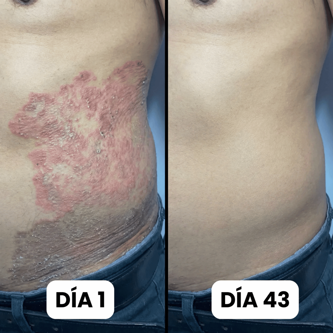 DermaForte Pro: Fórmula clínica intensiva para erradicar hongos y aliviar la picazón severa